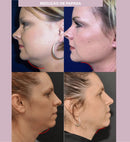 V-Revitalize™ - Máscara de Contorno Facial - Suaviza Rugas, Papada e Modela o Rosto